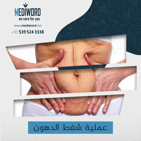 شفط الدهون